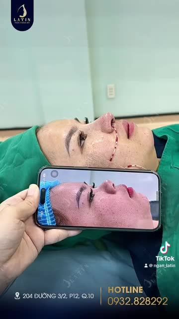 NÂNG MŨI CẤU TRÚC GIÚP KHUÔN MẶT THAY ĐỔI NHƯ THẾ NÀO