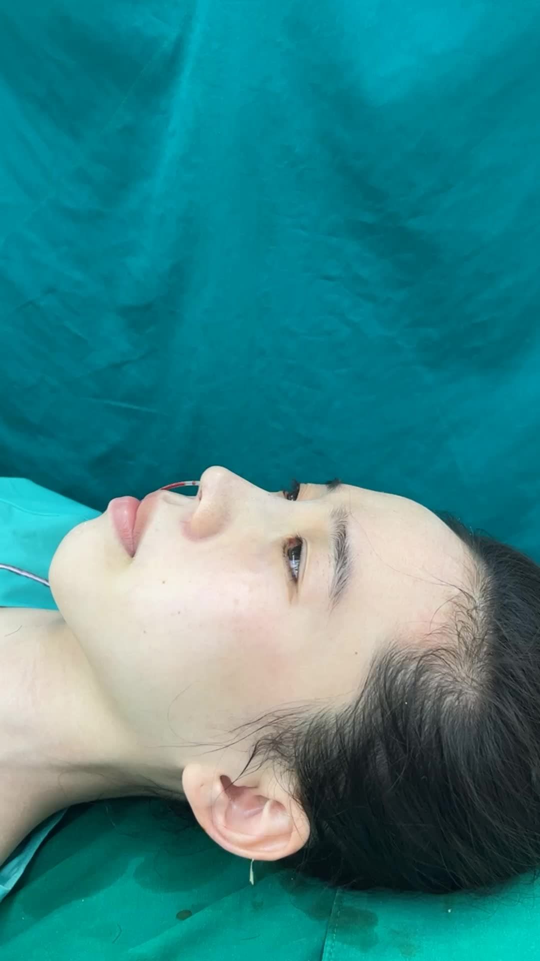 Case mũi bọc sụn vừa hoàn thành