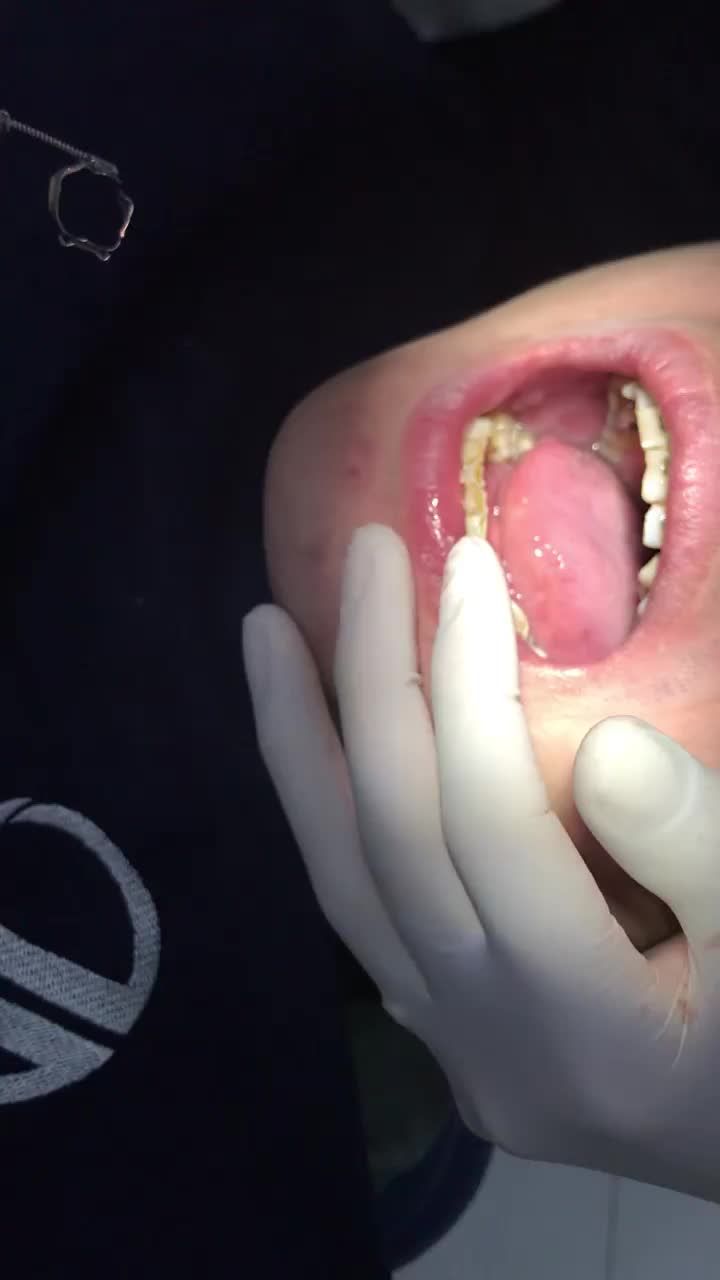 Khách hàng: VŨ ĐỨC ANH 30 Tuổi - Dịch vụ: Chỉnh nha + Thẩm mĩ 20 răng sứ