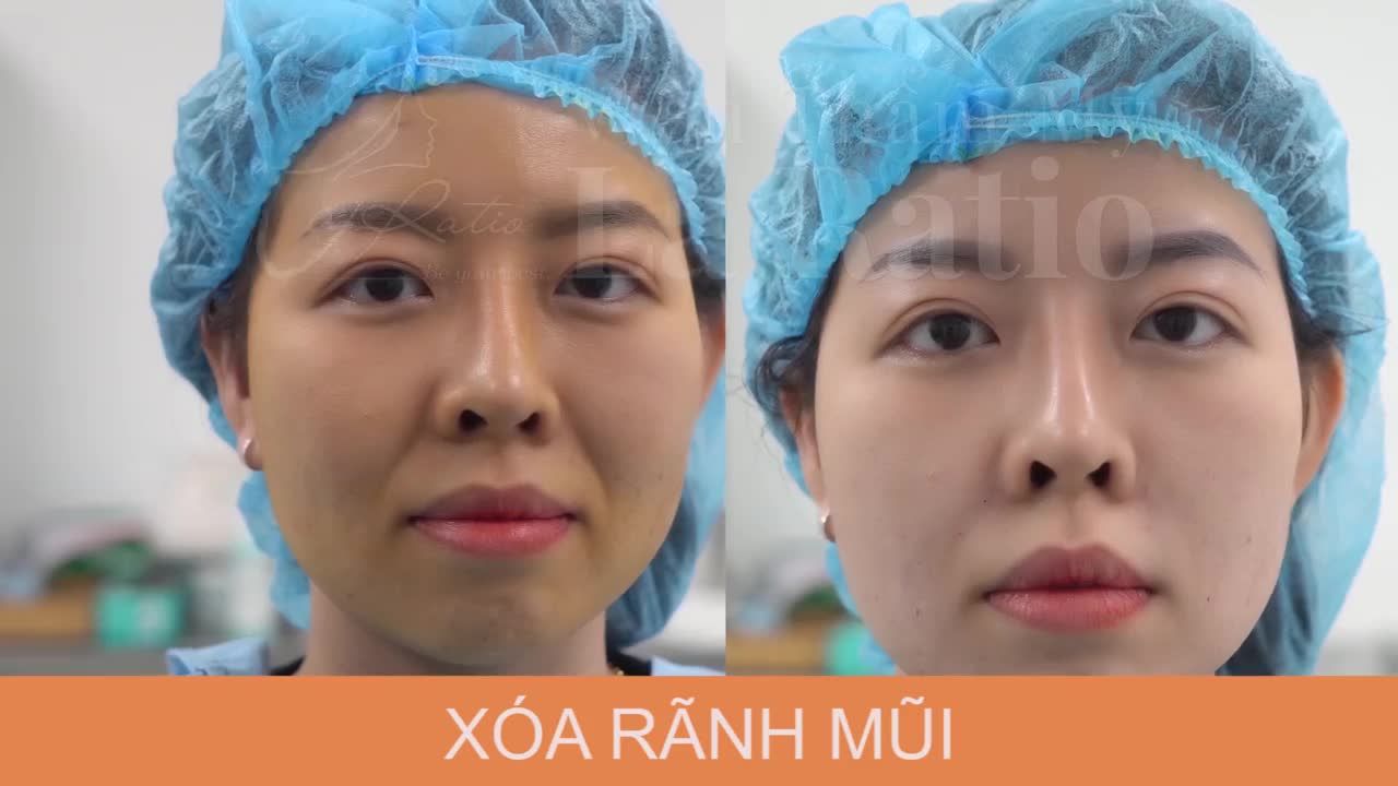 Rãnh mũi má là dấu hiệu rõ nhất tố cáo tuổi tác của bạn. Xóa nếp nhăn rãnh mũi tạ La Ratio chỉ sau 20 phút thực hiện: