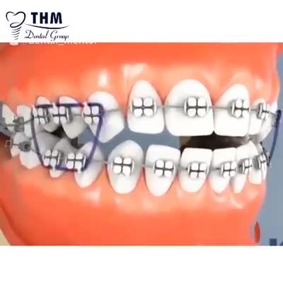 SỰ KÌ DIỆU CỦA NIỀNG RĂNG