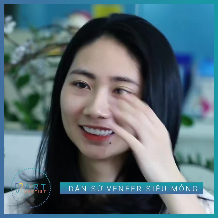 Dán sứ Veneer siêu mỏng