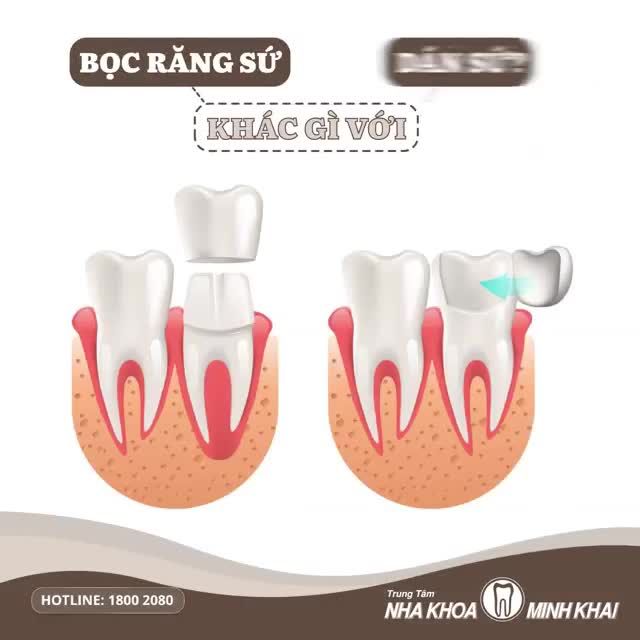 BỌC RĂNG SỨ KHÁC GÌ VỚI DÁN SỨ