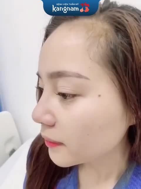 Combo Nâng mũi + Cắt cánh vừa làm xong