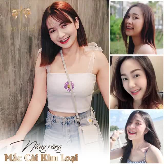 Hàm răng nhiều khuyết điểm đều trở nên hoàn hảo nhờ Niềng răng mắc cài kim loại tại Tấm Dentist