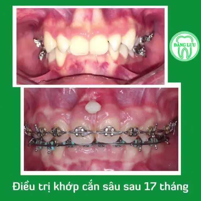 Khách hàng có tình trạng khớp cắn sâu 100% được điều trị bằng phương pháp Niềng răng tại Hệ thống Nha Khoa Đăng Lưu