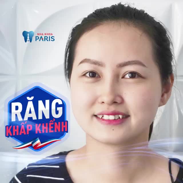 RĂNG KHẤP KHỂNH ĐỀU ĐẸP SAU 6 THÁNG