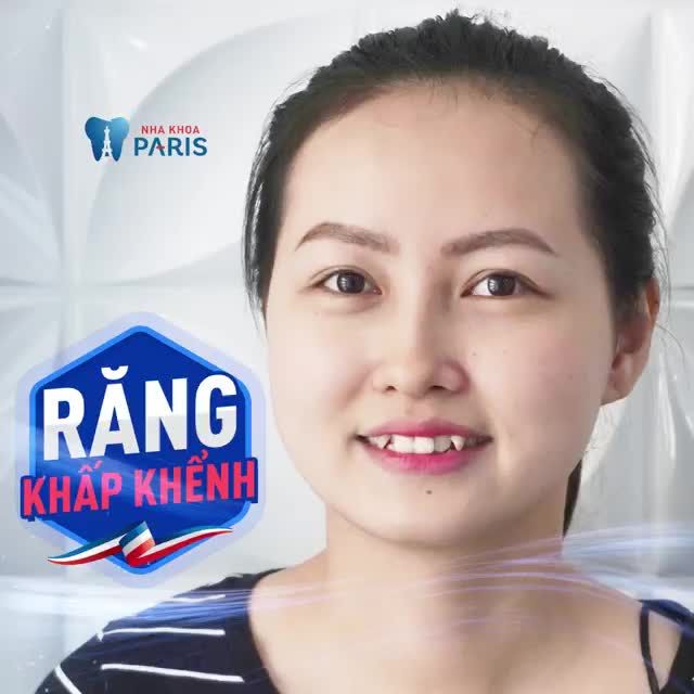RĂNG KHẤP KHỂNH ĐỀU ĐẸP SAU 6 THÁNG