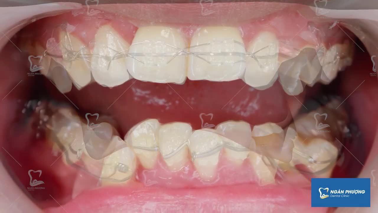 Sau 9 tháng niềng răng thì răng bạn sẽ thay đổi như thế nào