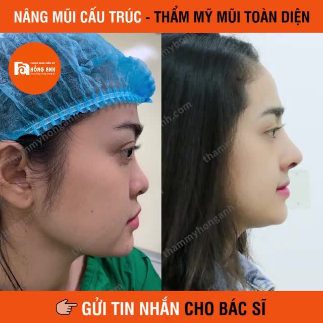 NÂNG MŨI CẤU TRÚC | Thẩm mỹ mũi toàn diện