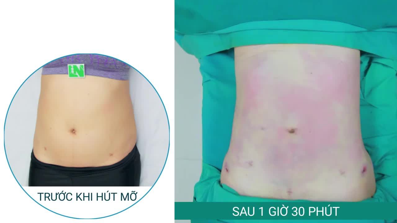 Video ngắn phản ánh CHÂN THỰC về kết quả vùng bụng sau gần 2 giờ thực hiện Hút mỡ tạo dáng thẩm mỹ của Chị Khách hàng (33 tuổi):