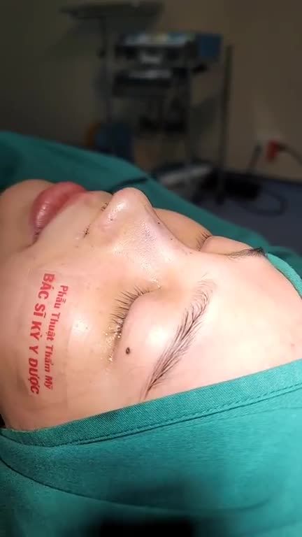 Mặc dù trước đó mũi rất thấp, sống to bè nhưng chỉ với 45 phút thực hiện Nâng mũi ALINE Bán Cấu Trúc Đa Lớp + Thu cánh mũi đã giúp chiếc mũi của chị khách thanh tú hơn hẳn.