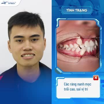 20 NĂM SỐNG KHÉP KÍN, NGẠI GIAO TIẾP VÌ HÀM RĂNG KHẤP KHỂNH, HÔ NẶNG, CHÀNG TRAI THAY ĐỔI NGỠ NGÀNG NHỜ NIỀNG RĂNG!