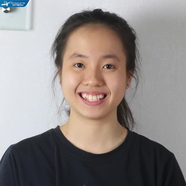 RĂNG CHEN CHÚC KHẤP KHỂNH BIẾN HÌNH CỰC CHẤT NHỜ NIỀNG RĂNG, HÔ BIẾN HÀM RĂNG TRỞ NÊN ĐỀU ĐẸP VÀ KHUÔN MẶT VLINE CHUẨN HÀN