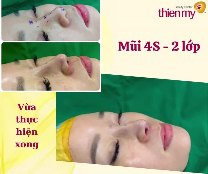 Nâng mũi bọc sụn 4S-2 lớp là phương pháp độc quyền tại TMV Thiện Mỹ được nhiều chị em yêu thích. Bởi các ưu điểm sau: