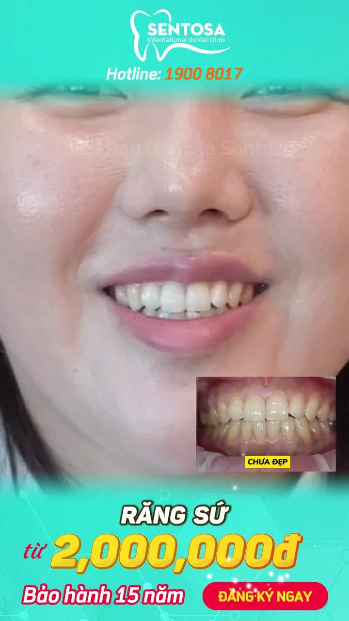 BỌC SỨ KHÔNG ĐAU, KHÔNG Ê BUỐT TẠI NHA KHOA SENTOSA