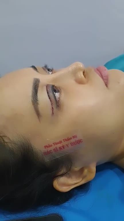 Tình trạng nhược cơ nâng mi bẩm sinh làm cho đôi mắt của khách hàng không mở to được, mí mắt sụp nhẹ, khiến cho khuôn mặt u buồn.