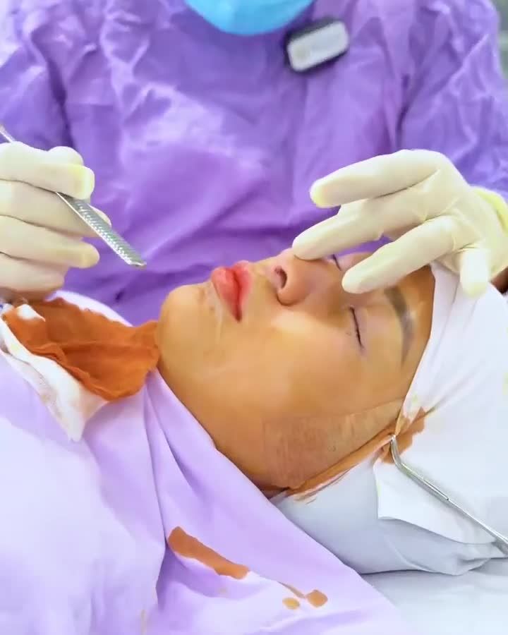Sử dụng sụn nâng chính hãng, duy trì kết quả lâu dài.
