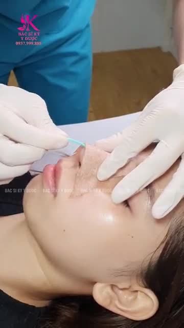 Mời cả nhà theo dõi dáng mũi của bạn khách sau 6 ngày Nâng Mũi ALINE.