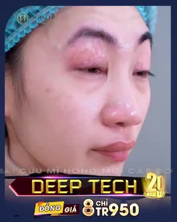 Case GIẢI CỨU MÍ LỖI HỎNG