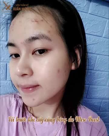 Làn da thâm mụn, khô sạm, đàn hồi kém sau 1 liệu trình cấy dưỡng chất Meso Boost sẽ như thế nào
