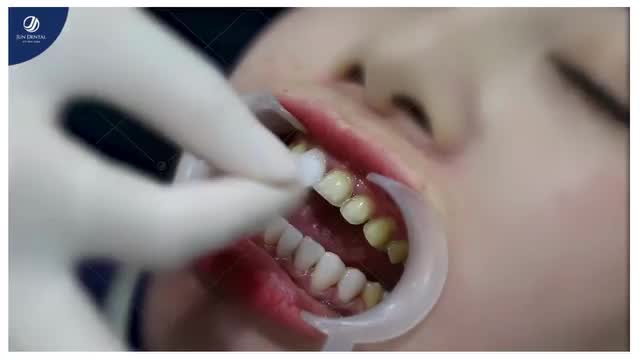 CẬN CẢNH DÁN RĂNG SỨ TẠI JUN DENTAL