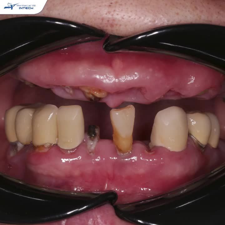 ÁM ẢNH MẤT RĂNG - NGẠI GIAO TIẾP, U70 NHẬN ĐƯỢC CÁI KẾT ẤM LÒNG KHI TRỒNG RĂNG IMPLANT TẠI LẠC VIỆT INTECH