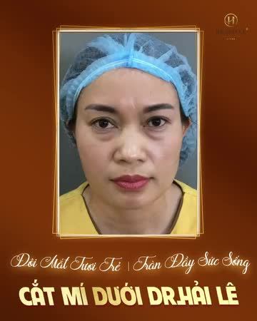 45 phút thực hiện, 7 ngày cắt chỉ, trả lại cho bạn đôi mắt long lanh rạng rỡ!