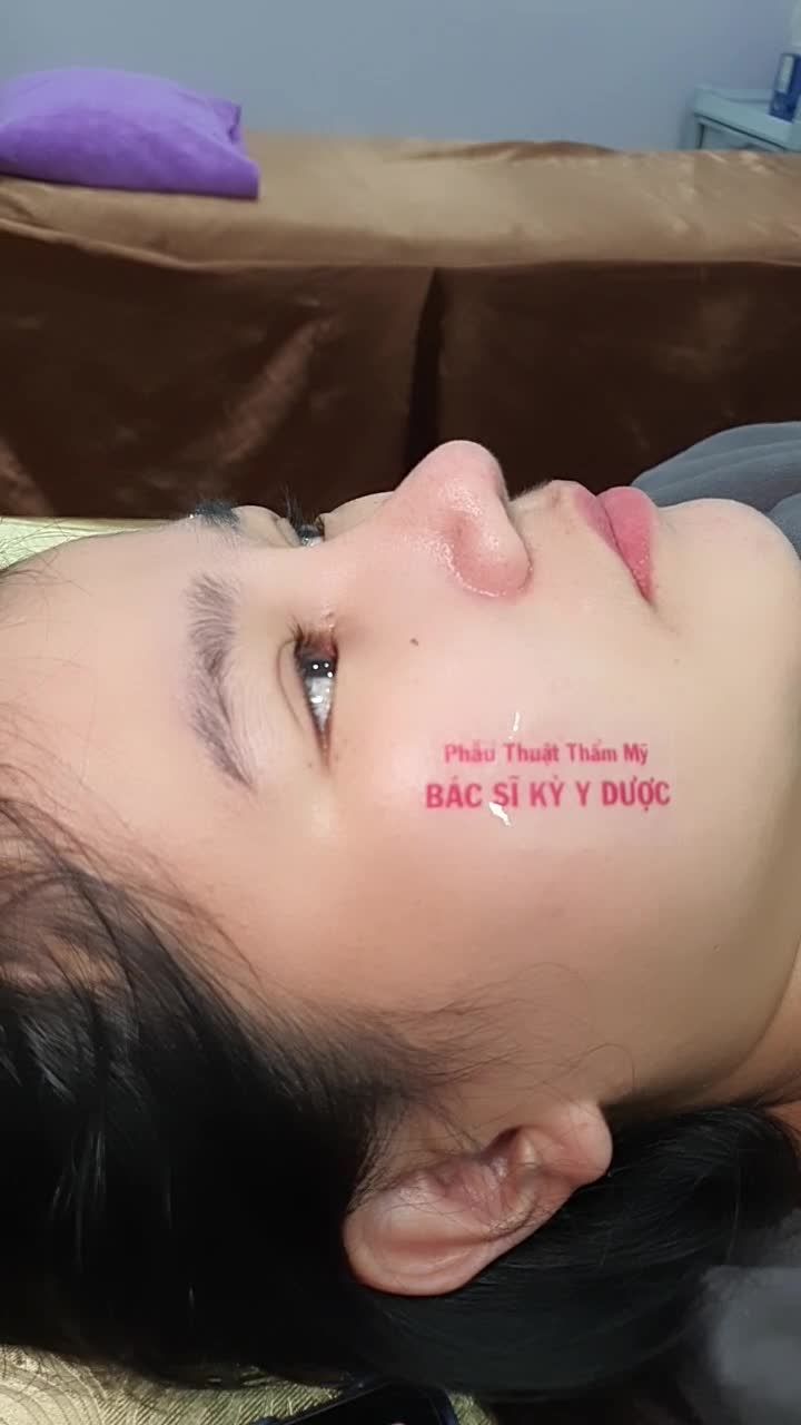 "LỘ DIỆN" NGAY DÁNG MŨI ALINE SAU 1 THÁNG 10 NGÀY PHẪU THUẬT