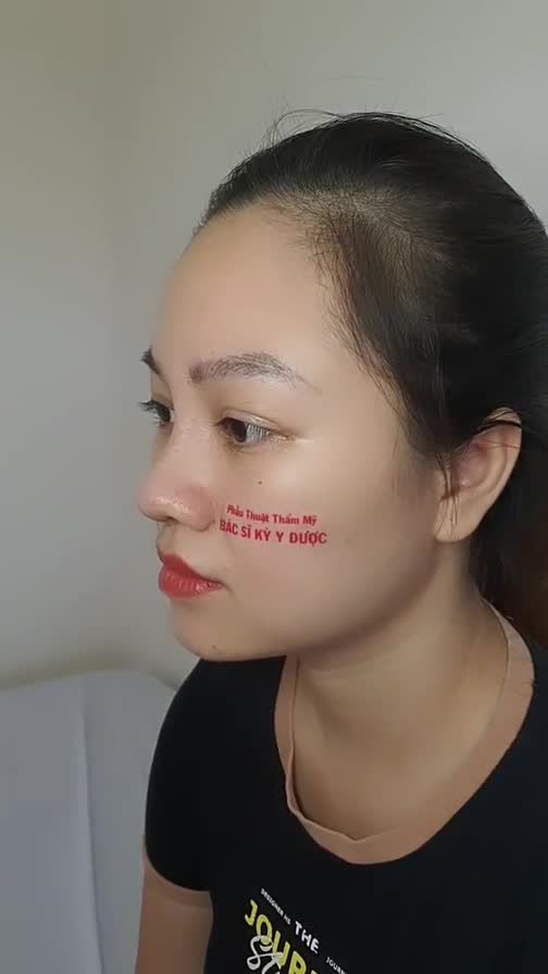 Kết quả Nâng Mũi ALINE sau 1 tháng tại Bác sĩ Kỳ Y Dược.