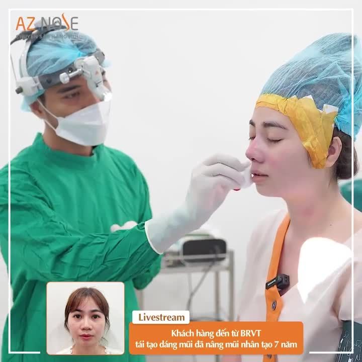Bác sĩ CKI. Đinh Xuân Sơn Tùng tái tạo dáng mũi cho khách hàng đến từ BRVT đã nâng mũi nhân tạo 7 năm.
