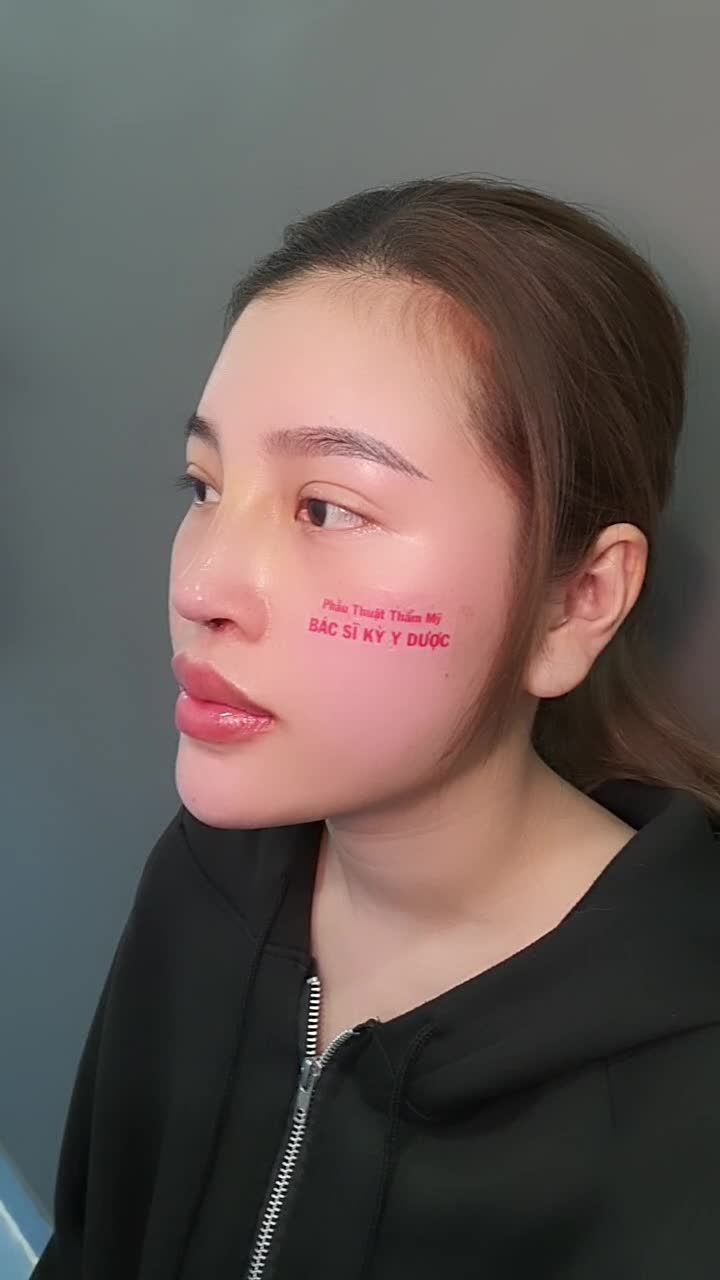 Dáng Mũi ALINE tại Bác sĩ Kỳ Y Dược, chỉ mới tháo nẹp thôi mà có cần xinh đến như vậy không?!