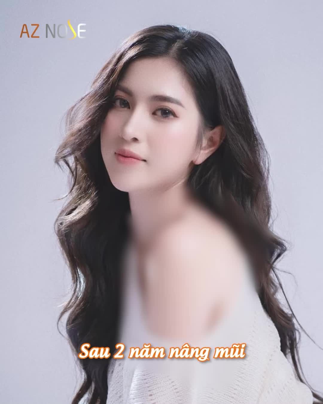 Từ Vũng Tàu đến AZ NOSE nâng mũi và sự thay đổi "hơn cả mong đợi"