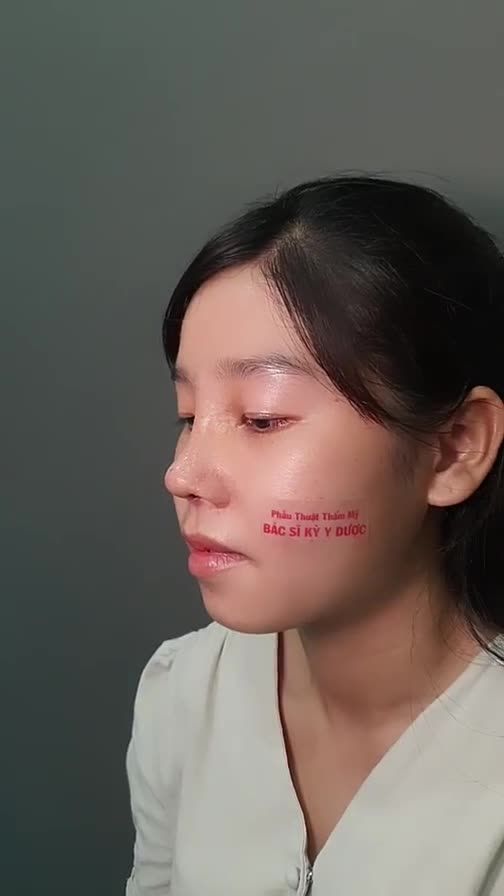 Tái khám Nâng Mũi Aline cho bạn khách từ Cần Thơ sau 8 ngày.