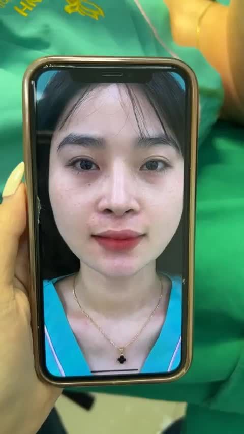 Case mũi cấu trúc surgiform vừa hoàn thành