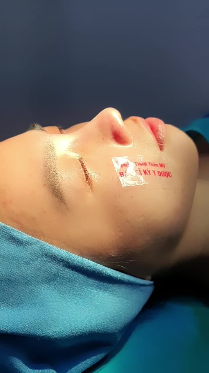 NÂNG MŨI ALINE SỞ HỮU NGAY DIỆN MẠO XINH XẮN