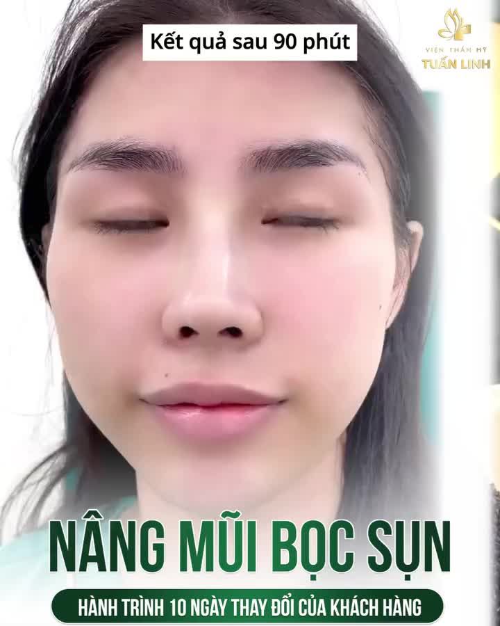 NÂNG MŨI BỌC SỤN - Hạn chế xâm lấn - Vào form nhanh chóng - Đẹp tự nhiên.