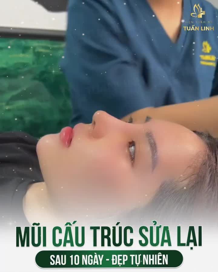Dáng mũi sau 10 ngày nâng cấu trúc sửa lại