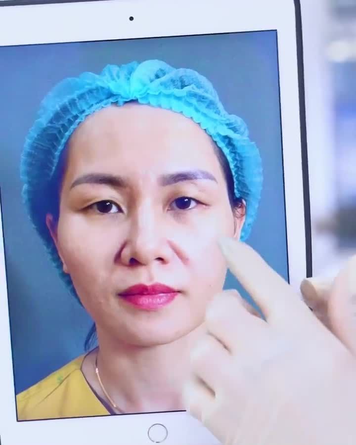Kết quả cắt mí mk vừa thực hiện xong giúp khách hàng trẻ ra 5-10 tuổi Cả nhà cùng theo dõi