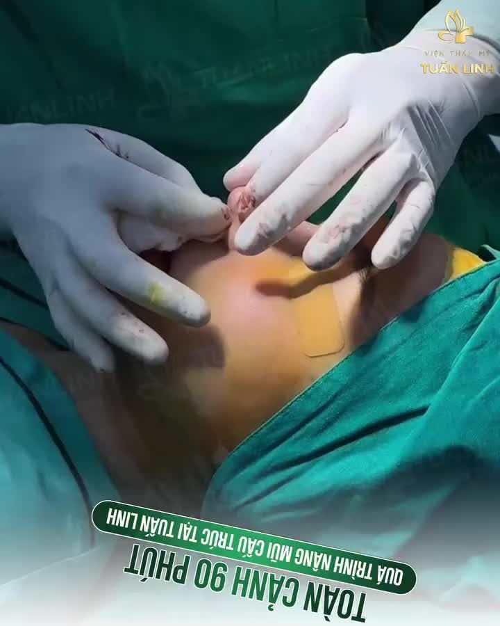 TOÀN CẢNH CASE NÂNG MŨI CẤU TRÚC - Thay dáng mũi, đổi phong thủy của khách hàng nhà Tuấn Linh.