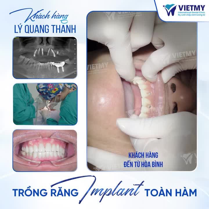 THÊM 1 CA IMPLANT THÀNH CÔNG MĨ MÃN CHO KHÁCH HÀNG ĐANG TUỔI "LỤC TUẦN", VƯỢT GẦN 100KM RA THỦ ĐÔ TRỒNG RĂNG