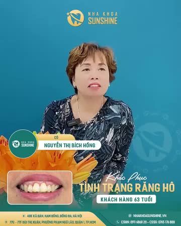 BỌC RĂNG SỨ KHẮC PHỤC RĂNG HÔ CHO KHÁCH HÀNG 63 TUỔI