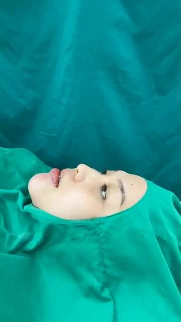 Case độn cằm 15tr vừa hoàn thành
