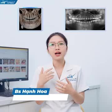NGUY CƠ RĂNG LUNG LAY, Ê BUỐT DO KHÔNG KIỂM SOÁT TỐT LỰC KHI CHỈNH NHA