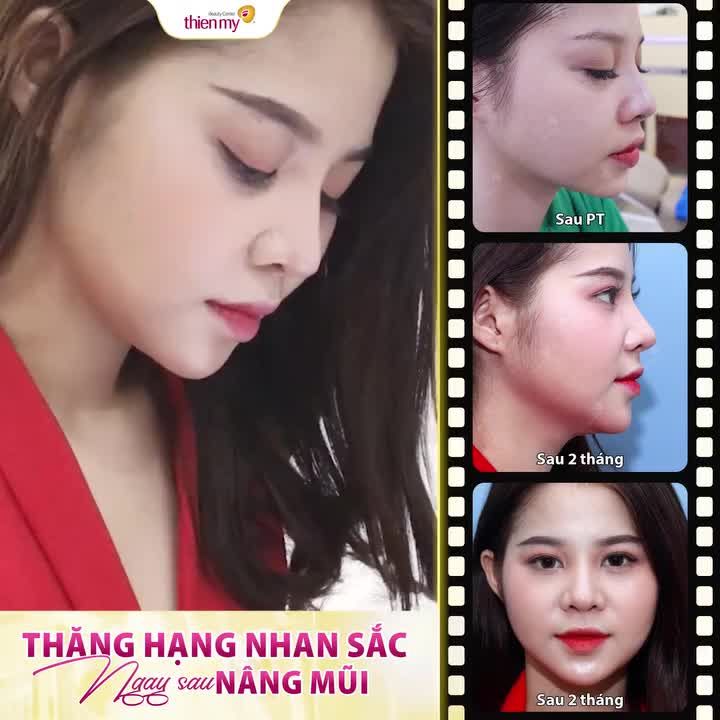 XINH NHƯ HOT GIRL sau NÂNG MŨI tại Thiện Mỹ. Xem ngay video dưới đây để thấy bạn khách hàng đã thay đổi ra sao nhé!