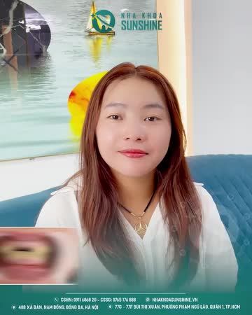 “Giải cứu” thành công ca răng sứ kim loại cũ bị hỏng do khách hàng làm ở cơ sở nha khoa không uy tín, tay nghề bác sĩ kém.