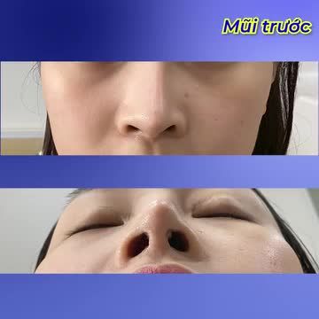 Nữ khách hàng từ Nam Định tìm tới TM Như Hoa - Tiến sĩ thẩm mỹ, bác sĩ Tống Hải với tình trạng mũi: từng sửa 2 lần nhưng vẫn lệch, tụt sụn.