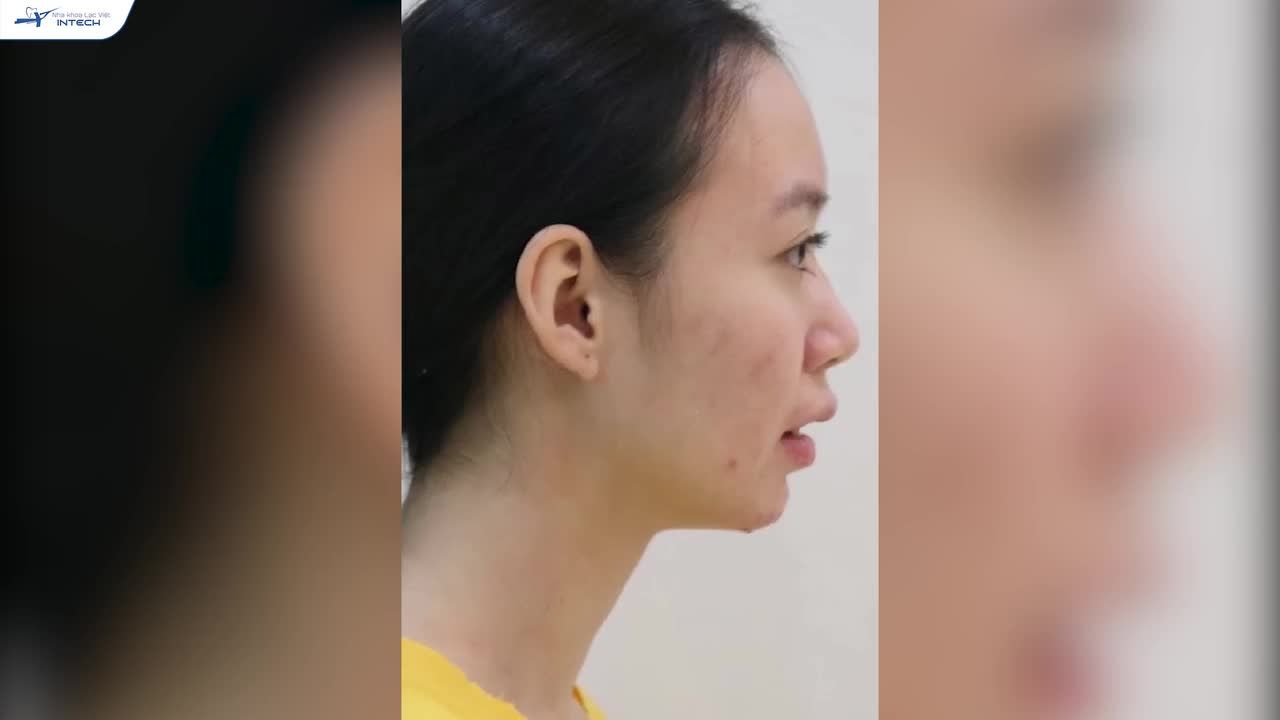 2 NĂM “BIẾN HÌNH” THÀNH HOT GIRL VẠN NGƯỜI MÊ NHỜ NIỀNG RĂNG X-MATRIX