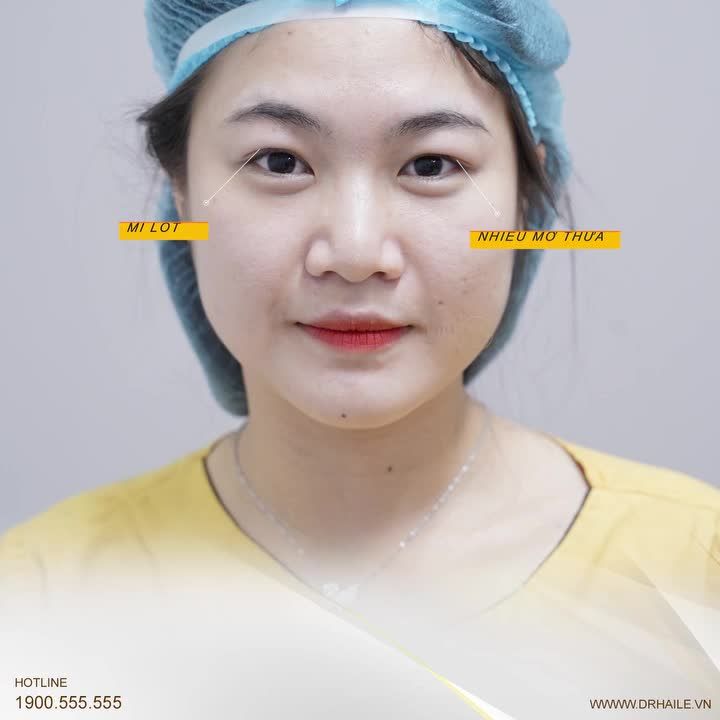 45 phút Cắt mí sở hữu ngay "cửa sổ tâm hồn" tươi trẻ, 2 mí sắc nét cực thu hút!