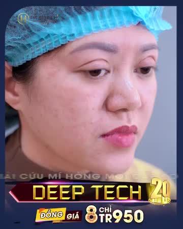 Bạn đang gặp tình trạng mí mắt lỗi hỏng đến ngay Dr.Hải Lê, khẳng định làm là đẹp, SỬA SẼ THÀNH CÔNG - Mí lỗi hỏng - ở đâu từ chối chúng tôi nhận - Dr.Hải Lê trao niềm tin nhận sự tự tin!